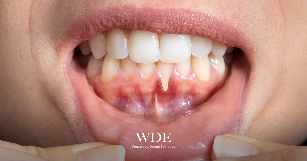  Close-up of receding gums exposing more of the tooth root, making the teeth appear longer.