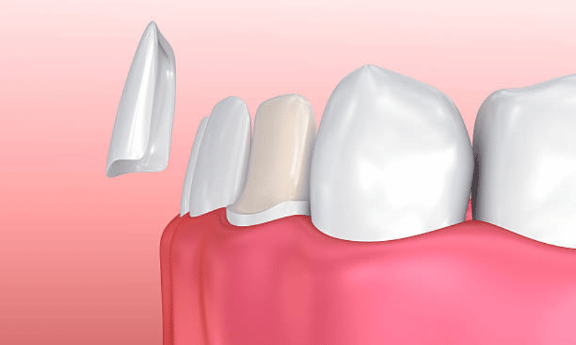 What Are Veneers? Why They're Worth It! Look Forward To The Dentist