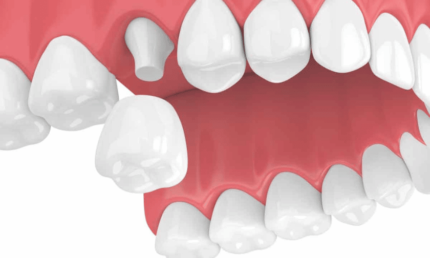 dental crowns