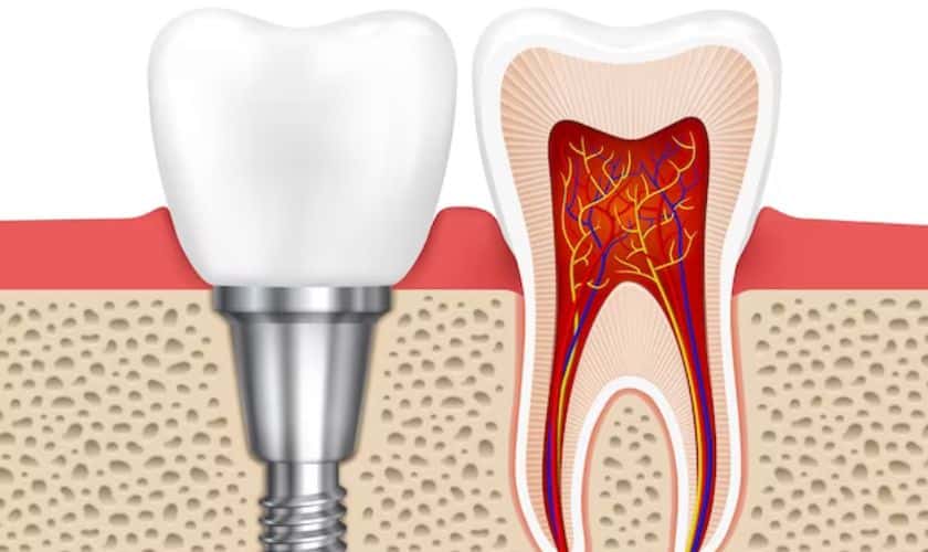 Dental Implant In Westwood Dental Esthetics Los Angeles Ca