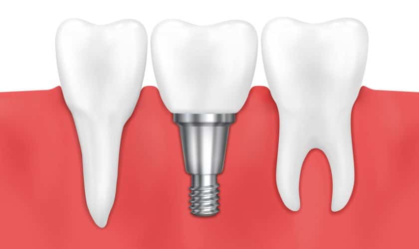 Dental Implants in Los Angeles CA