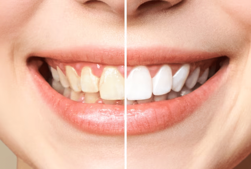 Teeth Whitening in Los Angeles, CA