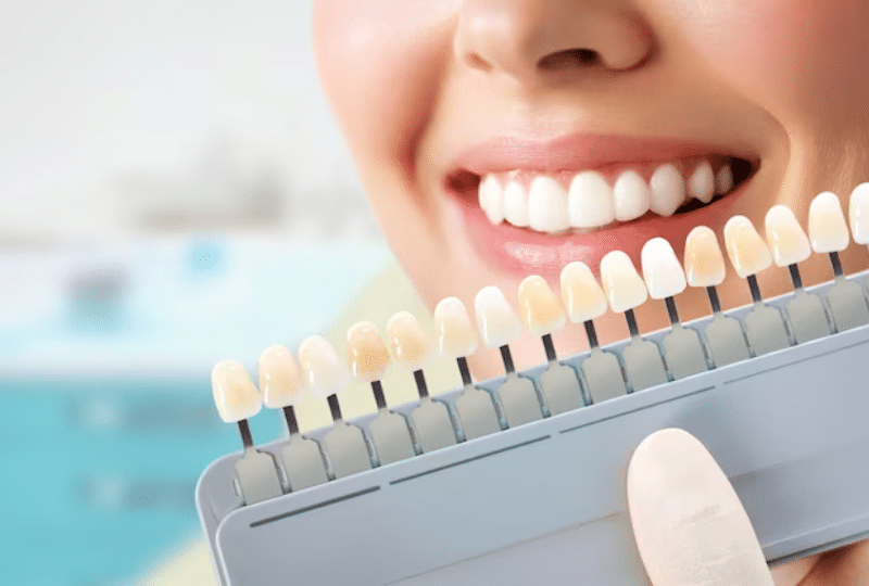 Veneers and their Impact on Bite Alignment
