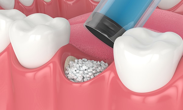 Bone Grafting in Los Angeles, CA - Westwood Dental Esthetics