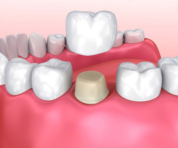 Dental Crowns in Los Angeles, CA - Westwood Dental Esthetics