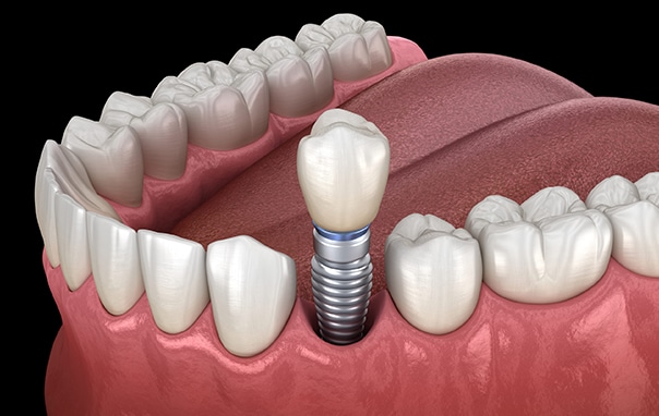 Dental Implants in Los Angeles, CA - Westwood Dental Esthetics