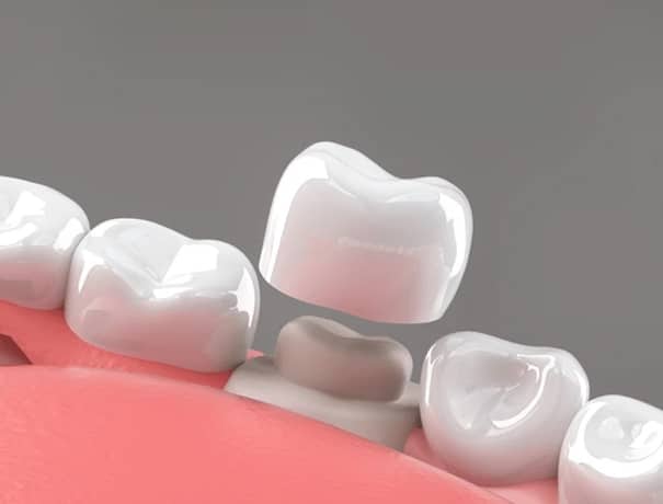 Porcelain Crowns in Los Angeles, CA - Westwood Dental Esthetics