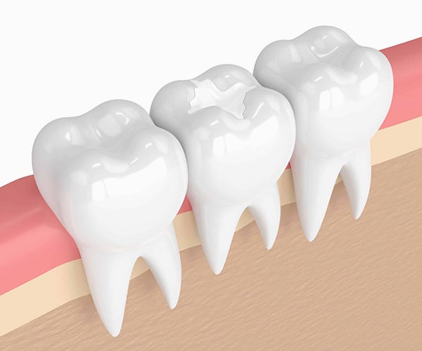 White Fillings in Los Angeles, CA - Westwood Dental Esthetics