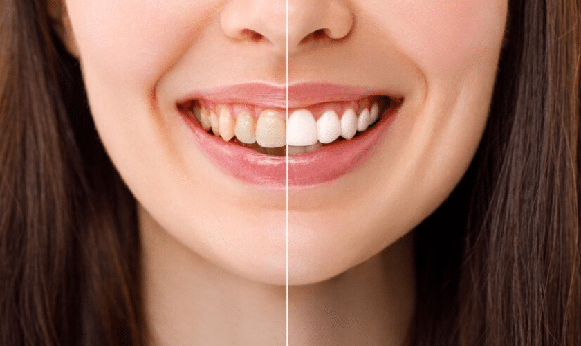 Brighten Your Smile- Safe and Effective Teeth Whitening for Sensitive Teeth