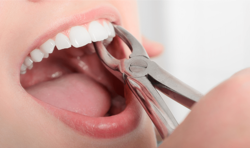 Top Reasons for Tooth Extraction and How to Prevent Them