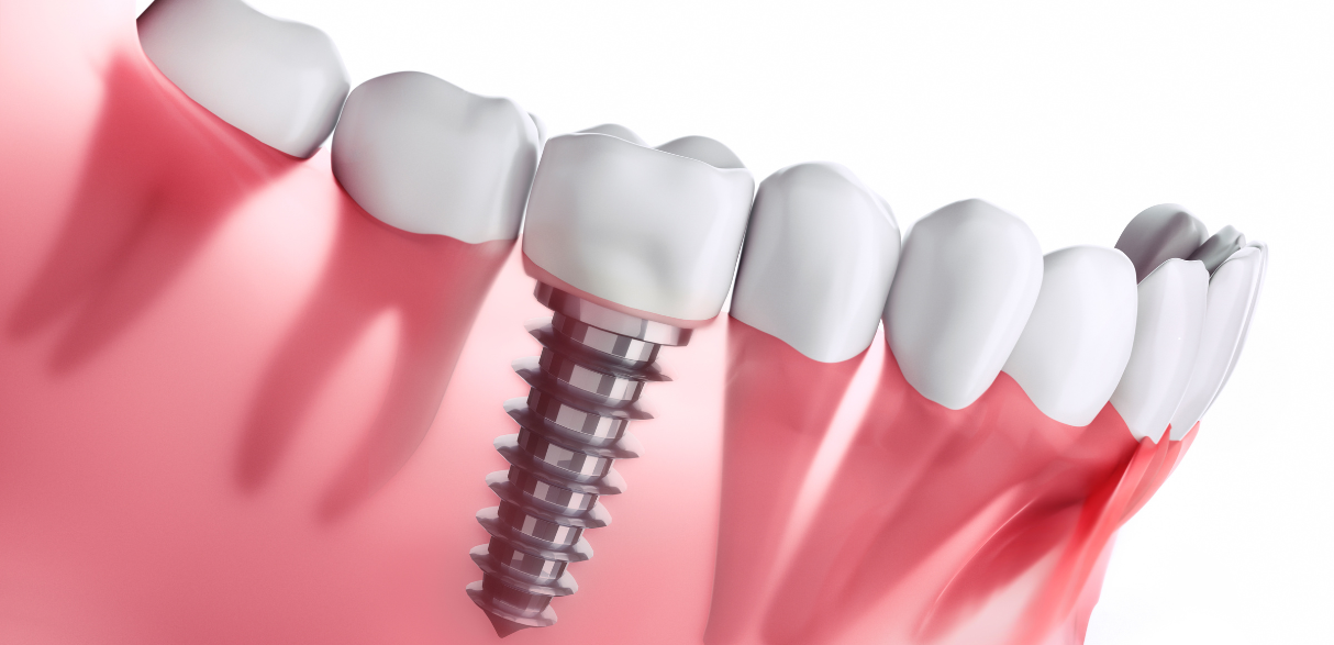 Why Bone Health Matters for Successful Dental Implants?