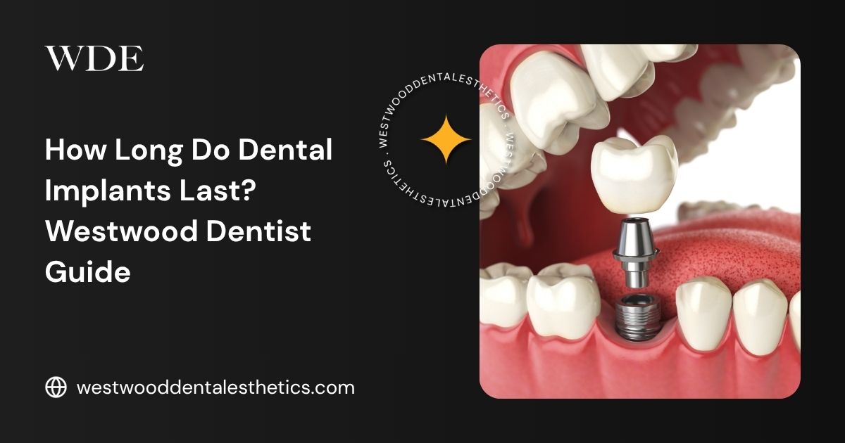 Dental implant diagram showing the implant fixture, abutment, and crown used to explain the longevity of dental implants.
