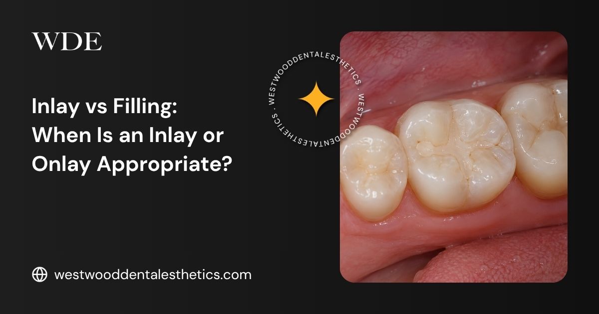Close-up of posterior teeth illustrating dental restoration options for an inlay, onlay, or traditional filling.