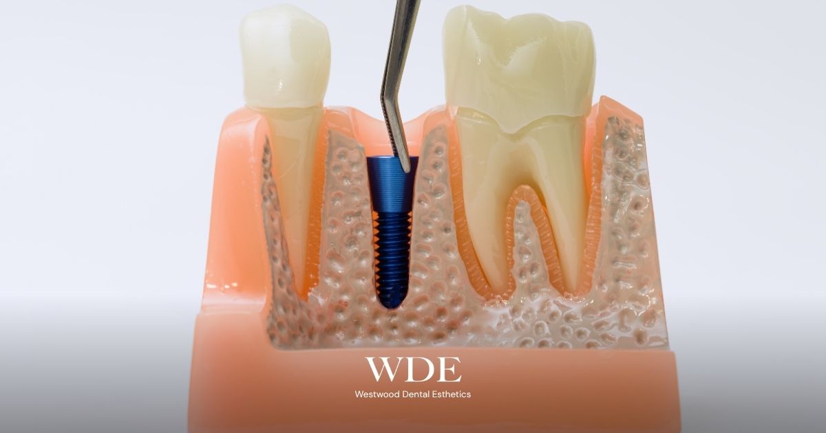 Dental implant model demonstrating osseointegration between a titanium implant and healthy jawbone tissue.
