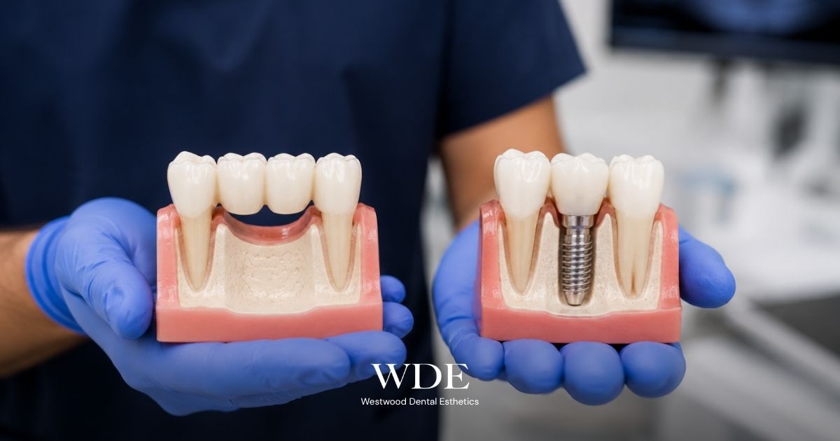Dental models demonstrating the differences between a fixed dental bridge and a dental implant restoration.