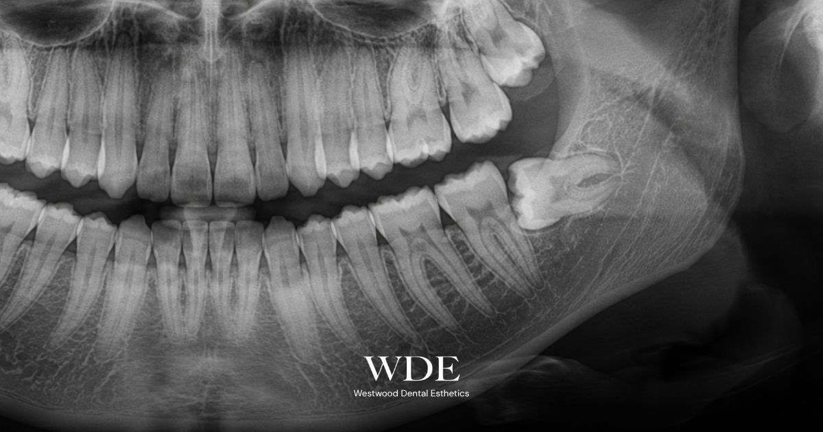 Panoramic dental X-ray showing an impacted lower wisdom tooth, illustrating how imaging helps evaluate tooth position, root anatomy, and nearby structures before extraction.