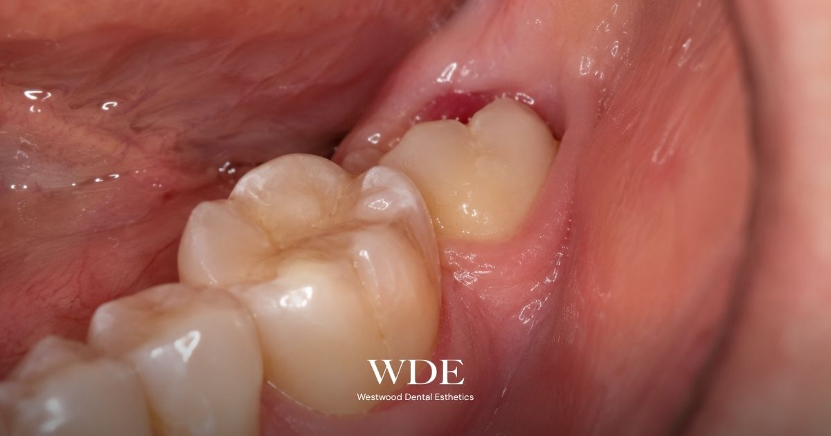 Partially erupted wisdom tooth behind the second molar, demonstrating a clinical situation that may require wisdom tooth extraction.