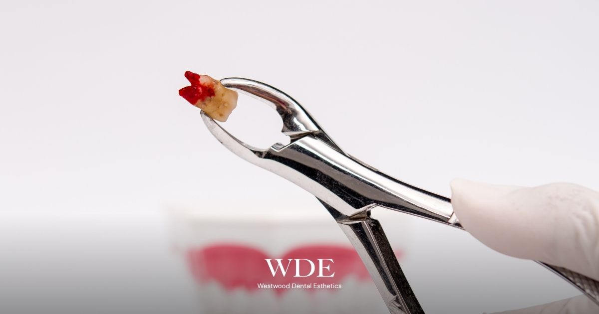 Extracted tooth held with dental forceps, demonstrating a standard tooth extraction performed by a dentist.