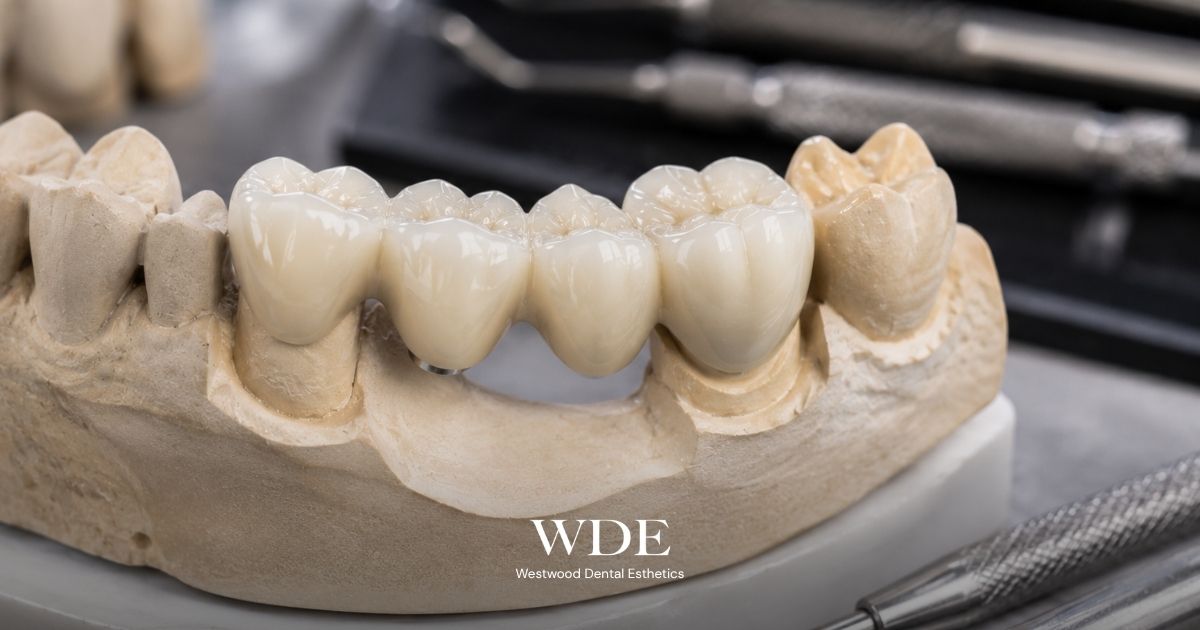 Close-up of a dental bridge on a tooth model illustrating how a fixed bridge connects multiple teeth during Invisalign treatment planning.
